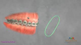 Orthodontic Treatment for Gummy Smile  TAD and Elastics [upl. by Lail]