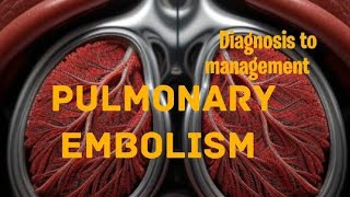 Pulmonary embolism  From Diagnosis to management [upl. by Reseta453]