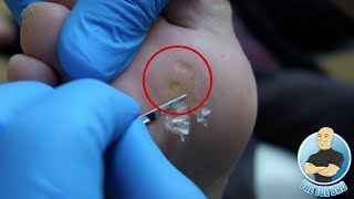 Removal of Painful Foot Callus and Corns for Diabetic Patient 15 Years of Suffering [upl. by Ainehta331]