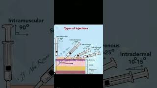 Types of injection doctor injection youtubeshorts [upl. by Jecho]