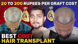 Cost Of Hair Transplant In India  Hair Transplant mein Kitna Kharcha Hota Hai [upl. by Casimire]