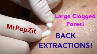 Deep clogged pores on the back extracted Blackhead removal up close by the dozens [upl. by Pare]