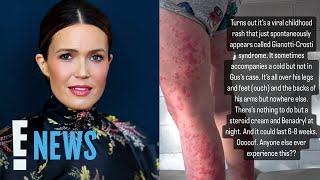 Mandy Moore Reveals Her 2YearOld Son Gus Has GianottiCrosti Syndrome  E News [upl. by Granny]