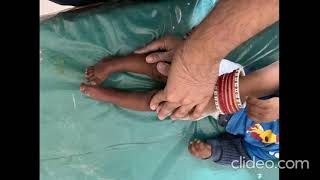 Bilateral Congenital Talipes Equino Varus Clubfoot [upl. by Enelegna]