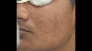 Comedones Removal Pimple treatment by Dr Paras Panot Dermatologist [upl. by Carmita]