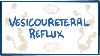 Vesicoureteral reflux  causes symptoms diagnosis treatment pathology [upl. by Ayekel]