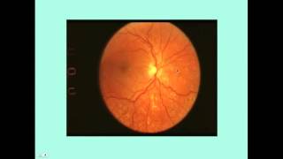 Hypertensive Retinopathy  CRASH Medical Review Series [upl. by Cart]