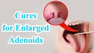 Natural Remedies and Natural Treatment for Enlarged Adenoids in Children  Health Benefits [upl. by Westphal884]