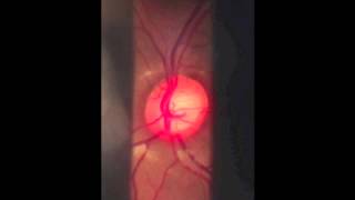 Indirect Ophthalmoscopy final [upl. by Cristionna575]