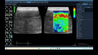 IQ 281 HEPATOMA ECHOPAC ANALYSIS ULTRASOUND ELASTOGRAPHY [upl. by Louisa]