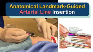 How To Succeed At Arterial Line Insertion Anatomical LandmarkGuided [upl. by Jojo719]