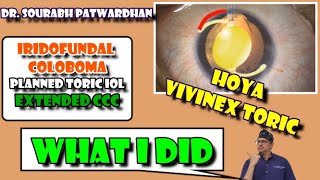 Hoya Vivinex Toric IOLcase of Iridofundal colobomaanterior capsular tear Dr Sourabh Patwardhan [upl. by Assenar]