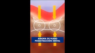 Por esto hay que reponer los dientes PERDIDOS  ATROFIA POSEXTRACCIÓN dental © [upl. by Juliet261]