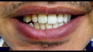 Crown can change your biting and smile without braces [upl. by Erund]