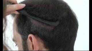 Hattingen Hair Transplantation 4000 FUs Follicular Unit Transplantation [upl. by Philemol]