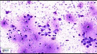 Cytology Thyroid nodule FNA  Metastatic breast carcinoma [upl. by Rhianna]