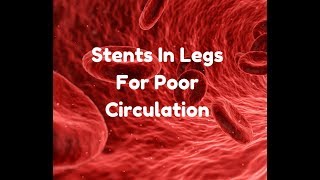 stents in legs for poor circulation [upl. by Laohcin203]