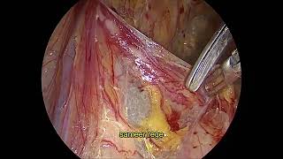 Laparoscopic left TEP Minimal edited [upl. by Thurber6]