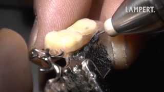 PUK dental welding  very low heat development [upl. by Noda888]