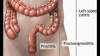 Treatment of Proctitis [upl. by Cowan]