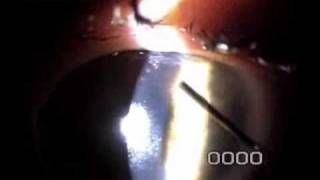 Slit Lamp Techniques  Epithelial Ingrowth Removal 8 days after LASIK Enhancement [upl. by Etnoled751]