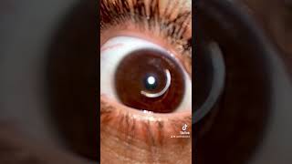 Eye drop Trend TikTok on Keratoconus [upl. by Azilef]