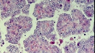 Thyroid Neoplasms  Pathology mini tutorial [upl. by Nabetse]