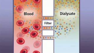 Hemodialysis and how it works  IKAN ch6  old vrs [upl. by Agemo]