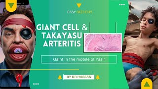 Large vessels vasculitis  Pathology  Visual Mnemonics  Crack NEET PG  USMLE PLAB [upl. by Kellen]