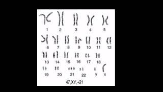 Down syndrome karyotype analysis third copy of chromosome 21 MR non dysjunction 95  of cases [upl. by Gile]