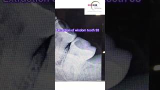 Painless EXTRACTION of Wisdom Tooth bhatiadentopulse toothpain extraction [upl. by Kayley]