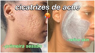 Cicatrizes de Acne  tratamento para remover cicatrizes refine skin [upl. by Aihtibat329]