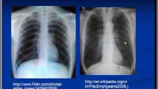 Chest xray interpretation COPD and Emphysema [upl. by Sapphira728]