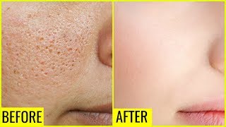 How to Get Rid of Large OPEN PORES Permanently  Anaysa [upl. by Fenner575]