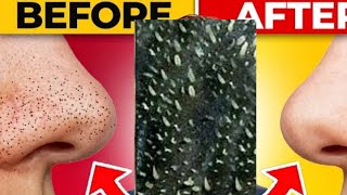 Blackhead Remove  How to remove Blackhead amp Nosehair  Nosehair amp Blackhead Remove Just 5 Rupee [upl. by Lubet]