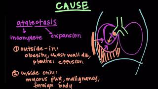 Ptx v Atelectasis [upl. by Alegnat549]