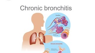 chronic bronchitis । medical surgical nursing1 । important topic । nursing nursingstudent study [upl. by Schulze]