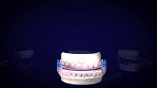 DentiTrac microrecorder fits all Dental oral appliances [upl. by Ennovahs]