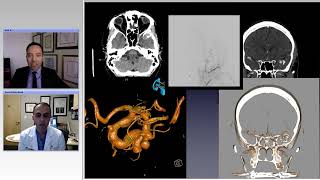 Revascularization Techniques for Treatment of Complex Aneurysms Preview [upl. by Kannav]