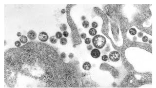 Lassa fever reported in US Plagues increasing [upl. by Shawn]