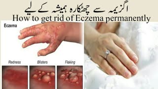 Eczema ka ilaj  Eczema between fingers in UrduHindi [upl. by Mckinney421]