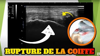 Echographie dune rupture de la coiffe des rotateurs [upl. by Kingsbury962]