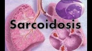 Sarcoidosis  sarcoidosis lung disease  sarcoidosis treatment  sarcoidosis radiology  symptoms [upl. by Gaddi767]