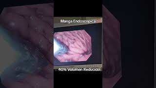 Manga Endoscopica 40 volumen reducido [upl. by Larrisa]