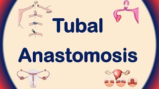 Tubal Anastomosis  Tubal Ligation Reversal  Tubal Reversal Procedure [upl. by Schroeder534]