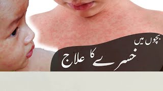 Treatment of measles  Bacho mein Khasry ka ilaaaj [upl. by Ahsrat]