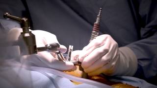 Minimally Invasive Laminectomy Surgery to Treat Lumbar Stenosis  MedStar Southern Maryland [upl. by Anselm]