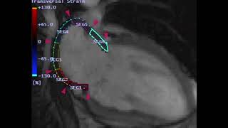 Afib Catheter Ablation Biomarker – Two Chamber View [upl. by Ergener464]