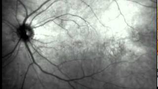 Eye Floaters Video [upl. by Krug604]