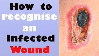 How to recognize an Infected Wound [upl. by Jarin]